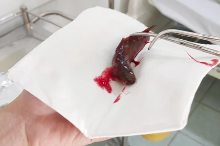 Con cá rô được bác sĩ gắp ra khỏi họng của người đàn ông. (Ảnh: Trung tâm Y tế huyện Giồng Riềng)