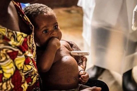 WHO tiếp tục xem xét tuyên bố tình trạng khẩn cấp với bệnh đậu mùa khỉ