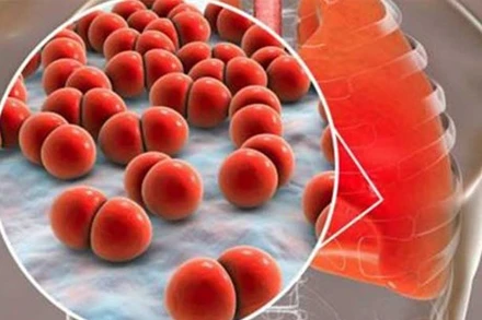 Cuba nghiên cứu phát triển vaccine chống lại phế cầu khuẩn