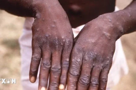 Bàn tay của bệnh nhân mắc đậu mùa khỉ tại CHDC Congo. (Ảnh: Getty Images/ TTXVN)