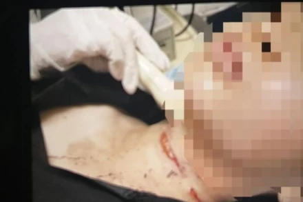 Vết cắt trên cổ là tự đối tượng gây ra trên cơ thể mình.