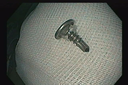 Cây đinh vít được các bác sĩ lấy ra từ bụng cháu bé.