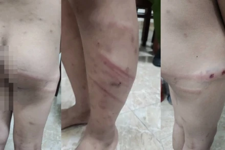 Hình ảnh cháu M. bị mẹ ruột và người tình của mẹ đánh đập gây thương tích nghiêm trọng.