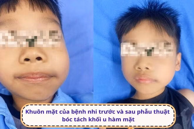 Khuôn mặt của bệnh nhi H trước và sau phẫu thuật bóc tách khối u hàm mặt.