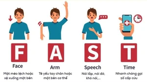 Nguyên tắc FAST của ngành y trong ứng cứu đột quỵ. 