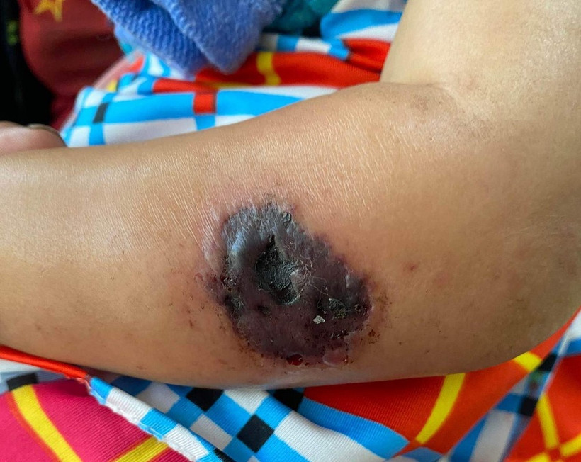 Biểu hiện bệnh than trên cơ thể của bệnh nhân thứ 14 vừa được phát hiện tại tỉnh Điện Biên.