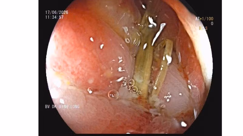 Hình ảnh nội soi ghi nhận dị vật dài khoảng 3cm, 1 đầu đâm sâu vào thành đại tràng, có dịch mủ chung quanh.
