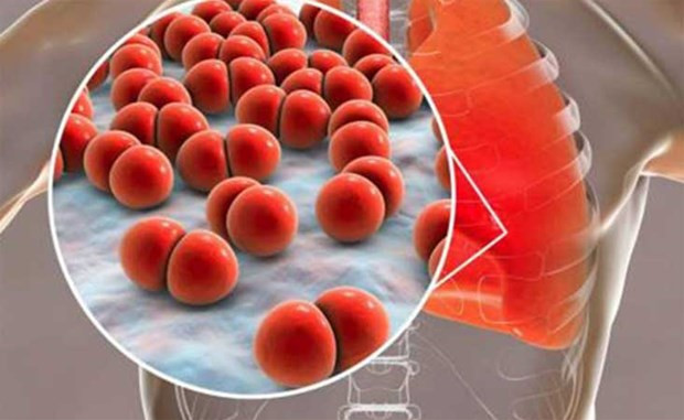 Phế cầu khuẩn là nguyên nhân gây ra khoảng 1,6 triệu ca tử vong trên toàn thế giới mỗi năm. (Nguồn: Plenglish)