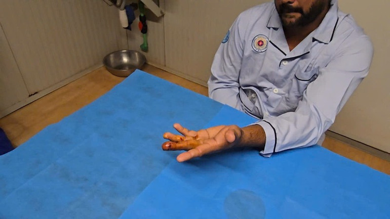 Ngón tay của bệnh nhân sau khi được phẫu thuật đang phục hồi tốt. (Ảnh: SỸ CÔNG)