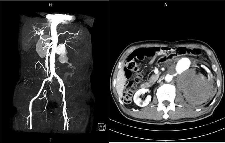 Hy hữu: Cứu sống người bệnh vỡ phình động mạch thận trái -0