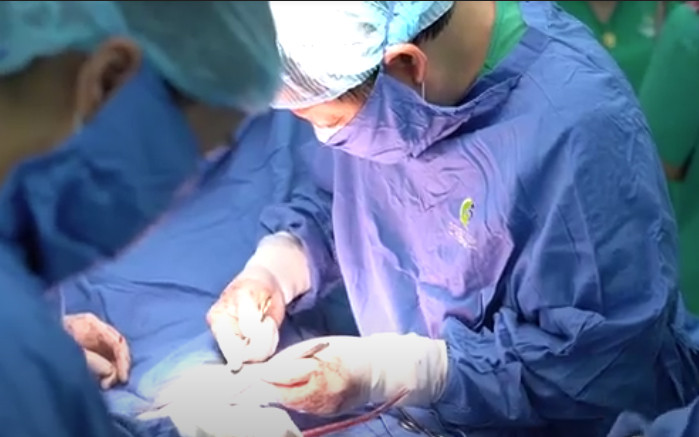 GS, TS Nguyễn Viết Tiến phẫu thuật can thiệp cho bệnh nhân. Vô sinh, hiếm muộn vì khối u xơ không ngờ tới -0