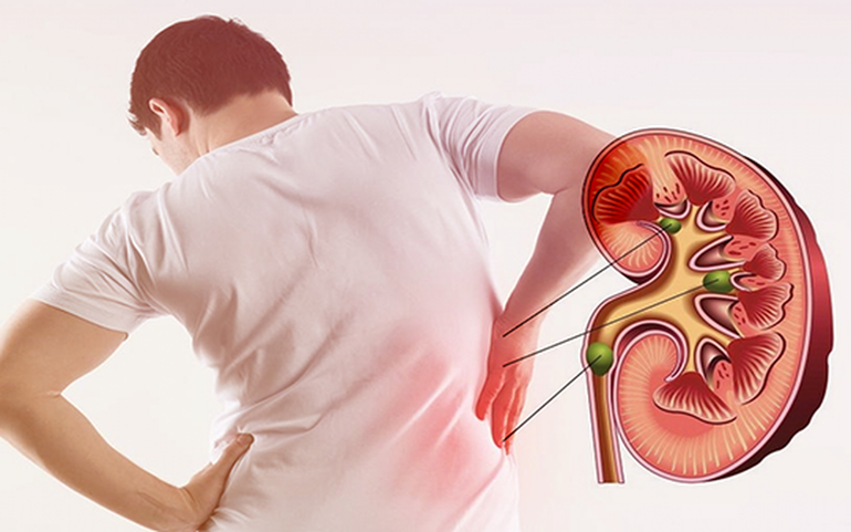 (Ảnh minh họa) Đừng để hỏng thận chỉ vì chủ quan tự điều trị thuốc nam -0