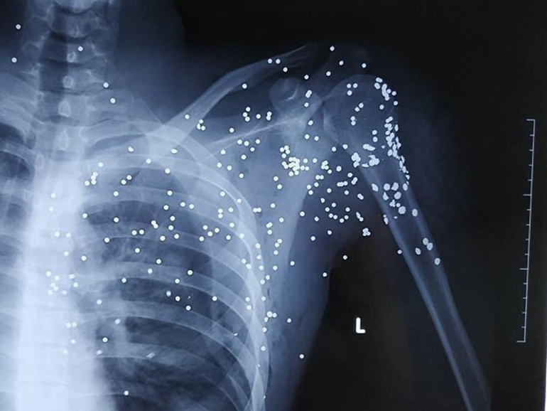 Truy tìm đối tượng bắn súng hoa cải làm một người nguy kịch -0