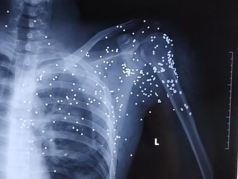 Truy tìm đối tượng bắn súng hoa cải làm một người nguy kịch -0