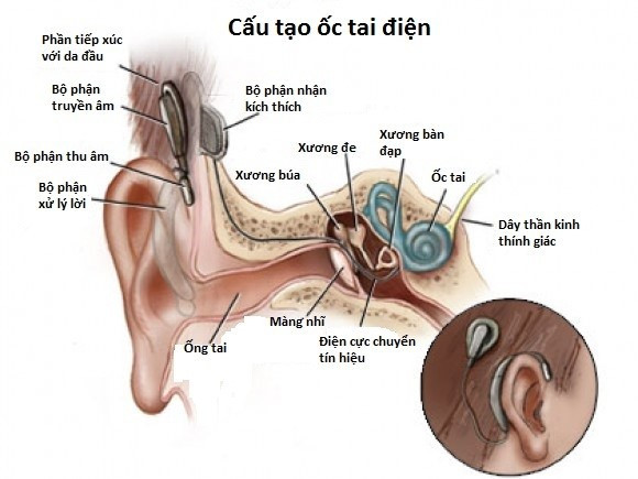 Thời điểm thích hợp nhất để cấy ốc tai điện tử cho trẻ điếc bẩm sinh -0