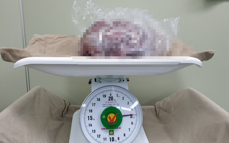 Khối u nặng 5kg của bệnh nhân. Đừng để căn bệnh GIST dạ dày lành tính trở thành ung thư -0