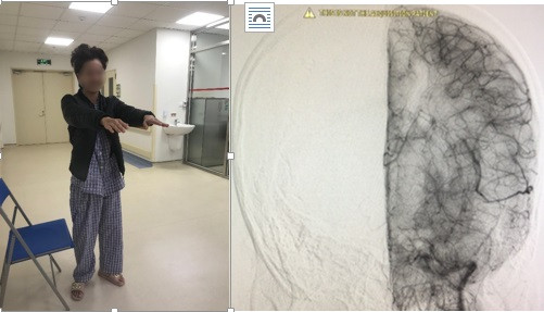 Cảnh báo nguy cơ chảy máu não ở người trẻ -0