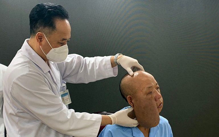 Bệnh nhân trước đó mang một khối u kỳ dị trên mặt. Tái tạo gương mặt mới cho người đàn ông mang khối u kỳ dị trên mặt -0
