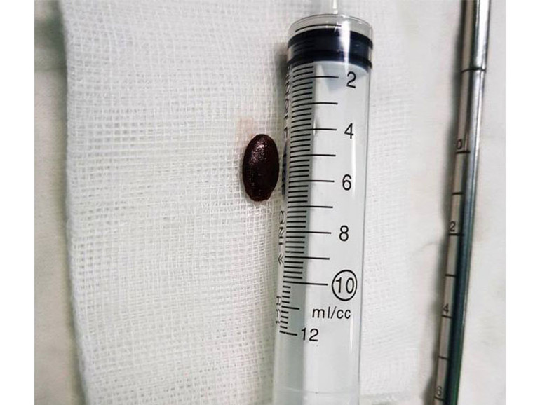 Cứu kịp thời cháu bé 23 tháng tuổi hóc hạt dưa -0