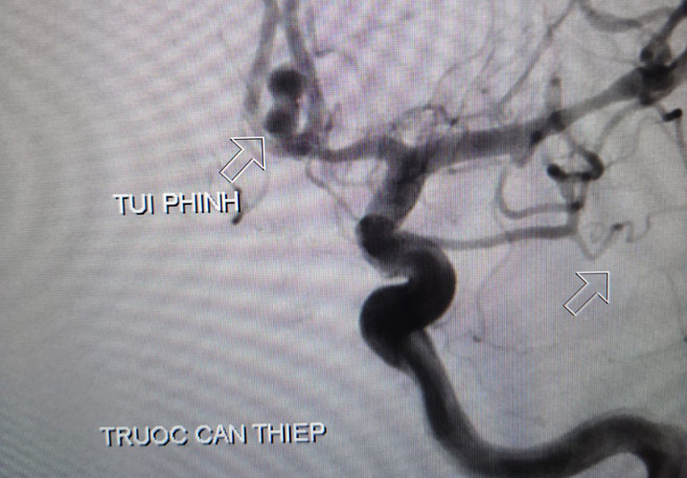 Cứu bệnh nhân Covid-19 vỡ túi phình mạch máu não -0