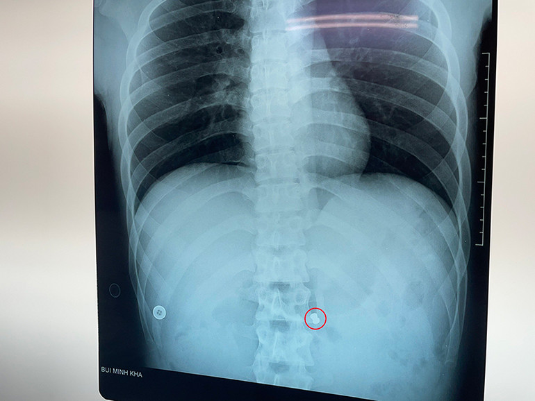 Cứu bệnh nhân bị đạn bắn thủng bụng -0