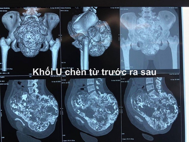 11 giờ căng thẳng loại bỏ khối u xương cùng cụt khổng lồ ảnh 1