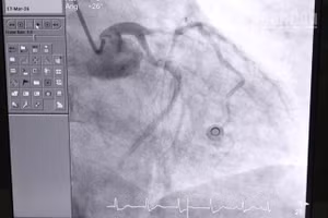 Sau khi can thiệp, tình trạng tim mạch của bệnh nhân dần ổn định, các chỉ số cải thiện rõ rệt. (Ảnh do đơn vị cung cấp)