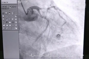 Sau khi can thiệp, tình trạng tim mạch của bệnh nhân dần ổn định, các chỉ số cải thiện rõ rệt. (Ảnh do đơn vị cung cấp)