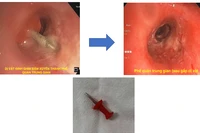 Hình ảnh nội soi ống mềm gắp dị vật đinh ghim xuyên thành phế quản trung gian.