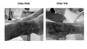 Bệnh nhân nữ nhập viện trong tình trạng tổn thương lóc da vùng cẳng chân hai bên do tai nạn giao thông, vết thương có nguy cơ hoại tử. (Ảnh: BVCC)