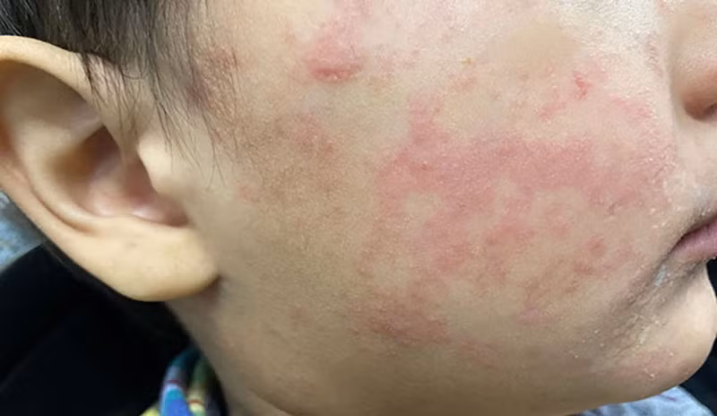 Má của một thiếu niên xuất hiện vết phát ban đặc trưng của bệnh sởi. (Ảnh: CDC Hoa Kỳ).