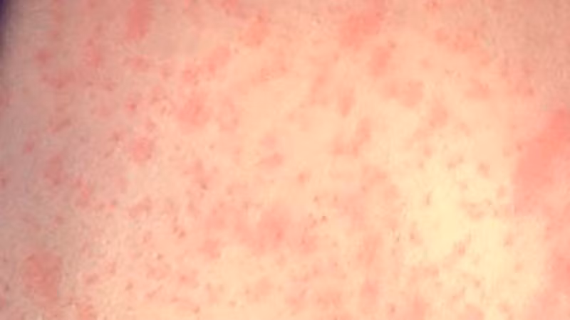 Da của bệnh nhân sau 3 ngày bị phát ban sởi. (Ảnh: CDC)