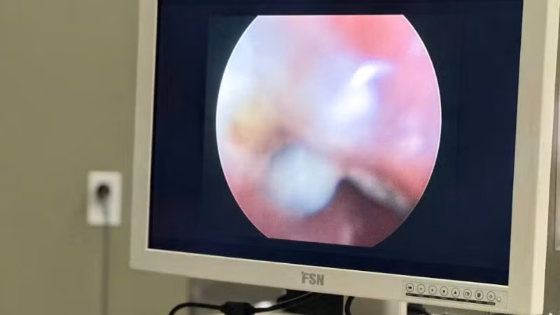 Thiết bị nội soi của Bệnh viện Sản-Nhi Cà Mau giúp phát hiện dị vật trong cơ thể của trẻ. (Ảnh do bệnh viện cung cấp)