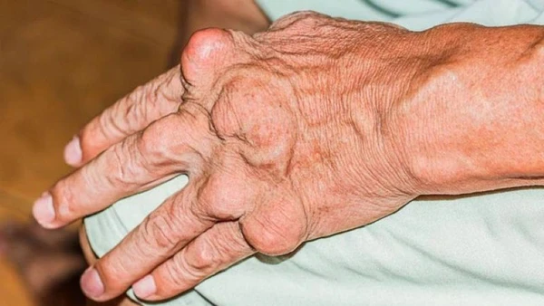 Gout là bệnh lý do sự rối loạn chuyển hóa nhân purin, làm tăng axit uric trong máu.