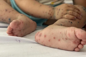 Các trường hợp bệnh nhân bệnh tay chân miệng mới đây đều là các em dưới 5 tuổi.