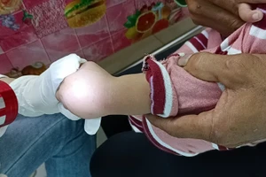 Một ca bệnh tay chân miệng tại thành phố Cần Thơ.