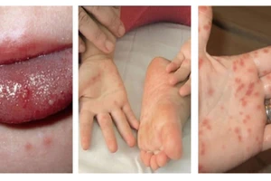 Những nốt ban do bệnh tay chân miệng có màu đỏ, sau đó tiến triển thành mụn nước vòm dày.(Ảnh minh họa)