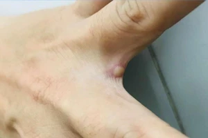 Bóng nước điển hình rải rác các vị trí khác nhau trên cơ thể người bệnh. (Ảnh: Bệnh viện cung cấp)