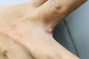 Bóng nước điển hình rải rác các vị trí khác nhau trên cơ thể người bệnh. (Ảnh: Bệnh viện cung cấp)
