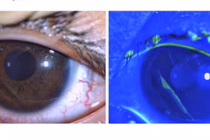 Hình ảnh trợt biểu mô giác mạc ở bệnh nhi 4 tuổi qua quan sát bằng sinh hiển vi có nhuộm soi Fluorescein (ảnh phải).