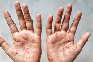 Các ban đỏ nổi trên tay một bệnh nhân mắc đậu mùa khỉ. (Ảnh: Shutterstock/TTXVN)