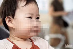 Bệnh nhi khám mắt tại Bệnh viện Mắt Trung ương. (Ảnh: THẾ KHẢI)