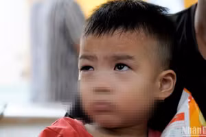 Trẻ đau mắt đỏ khám tại Bệnh viện Mắt Trung ương. (Ảnh: THẾ KHẢI)