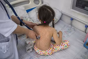 Một bé gái mắc bệnh sởi. Ảnh: WHO