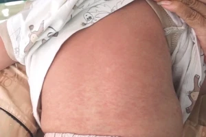 Các nốt phát ban trên trẻ bị bệnh sởi.