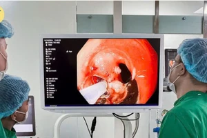 Nội soi cắt tách dưới niêm mạc (ESD) là kỹ thuật hiện đại hàng đầu thế giới trong điều trị ung thư sớm đường tiêu hóa.