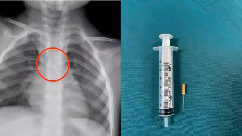 Dị vật trong đường thở của bệnh nhi. (Ảnh: Bệnh viện Đa khoa tỉnh Quảng Trị)