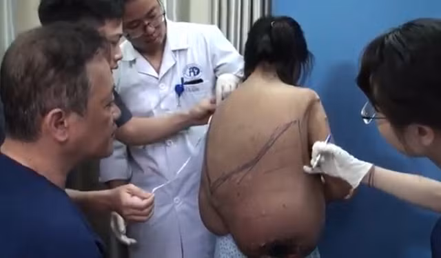 Khối u nặng khoảng 12 kg gây biến dạng cột sống.