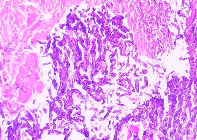 Nấm phổi: Căn bệnh hiếm gặp và nguy cơ tử vong cao