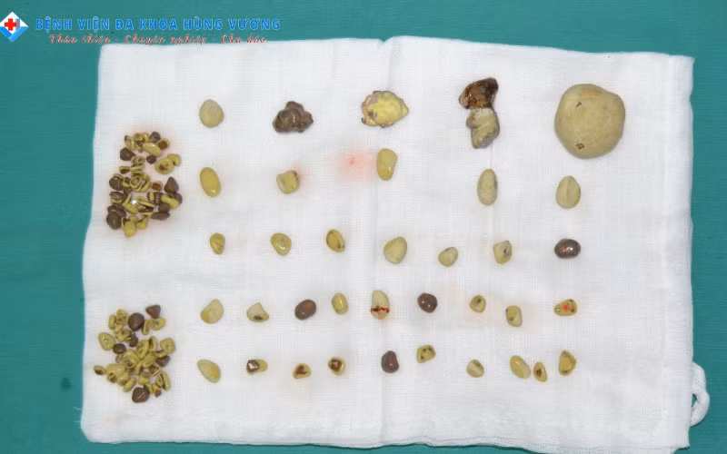 Hơn 100 viên sỏi được phẫu thuật lấy ra từ thận người bệnh